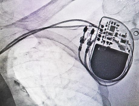 Permanent pacemaker x-ray image in cardiac catheterization