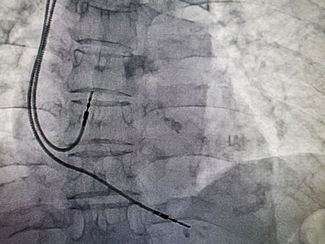 DDDR pacemaker cable in x-ray image in cardiac catheterization laboratory