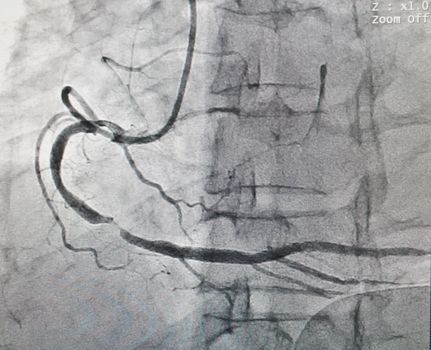 Severe disease at right coronary artery