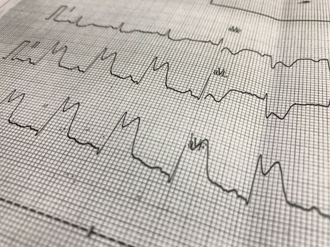 Close up ST elevation in leadI ll,lll on ECG paper