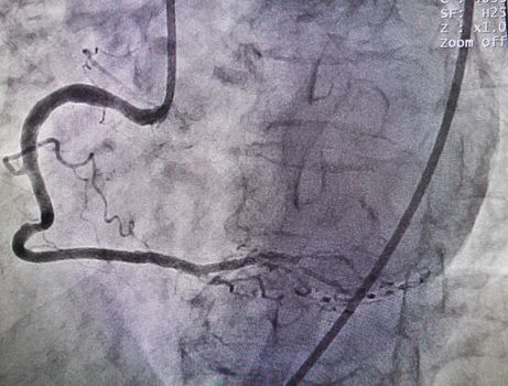 Right coronary artery from x-ray in cardiac catheterization laboratory