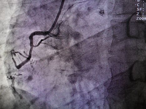 STEMI at right coronary artery from x-ray in cardiac catheterization laboratory