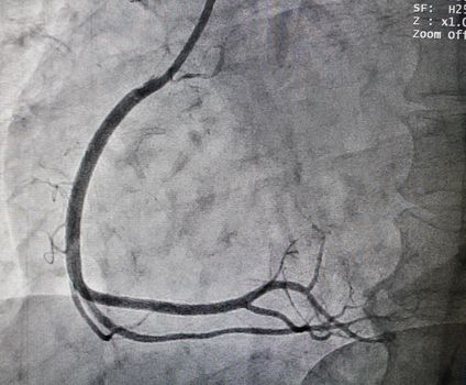 Normal right coronary artery in x-ray image in cardiac catherization laboratory