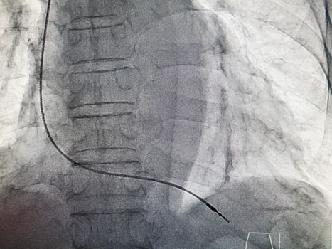 VVIR pacemaker cable in x-ray image in cardiac catheterization laboratory