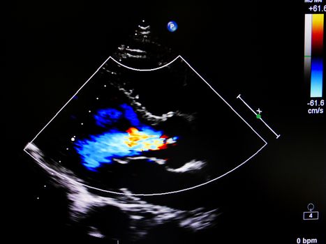 Flow color mode in echocardiogram in mitral valve regurgitation patient