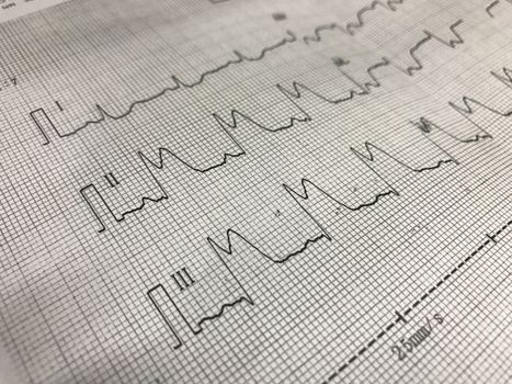 Close up ST elevation in leadI ll, lll on ECG paper