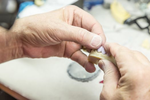 Male Dental Technician Working On A 3D Printed Mold For Tooth Implants In The Lab.