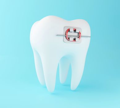 3D Illustration. Tooth with braces. Dental care concept.