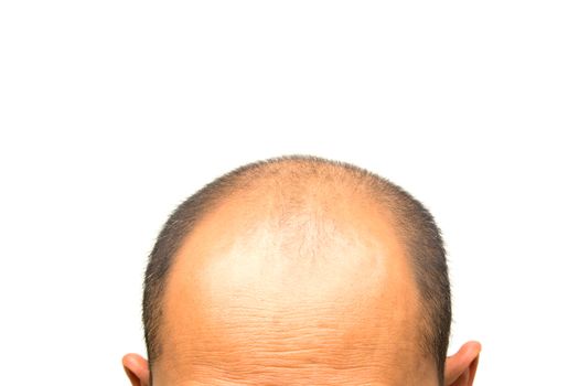 Head of man lose one's hair, glabrous on his head for elderly man