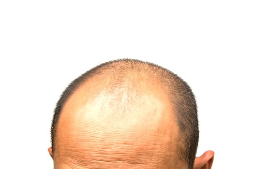 Head of man lose one's hair, glabrous on his head for elderly man