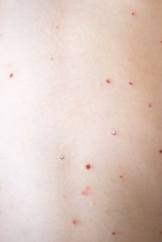 Chickenpox on the body of a young child, skin infection