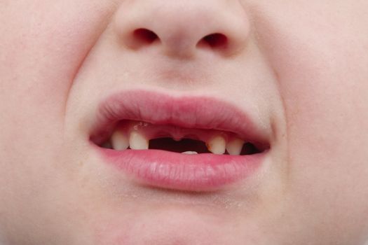 Close up of happy handsome boy showing his changing teeth