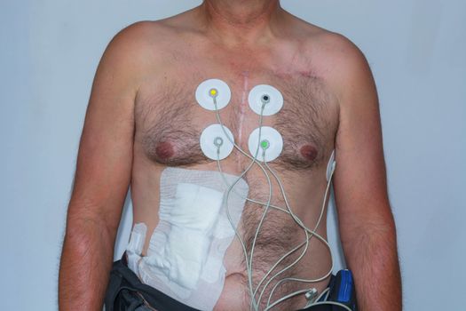 Naked upper body of a man with electrodes for measuring the heart tension curve for an electrocardiogram, ECG. Cable into the abdominal cavity of a left ventricular assist device.
