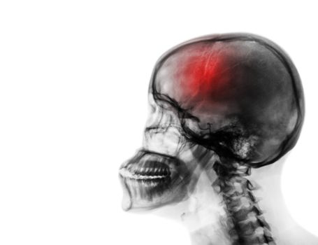 Stroke . Cerebrovascular accident . Film x-ray of human skull and cervical spine . blank area at left side .