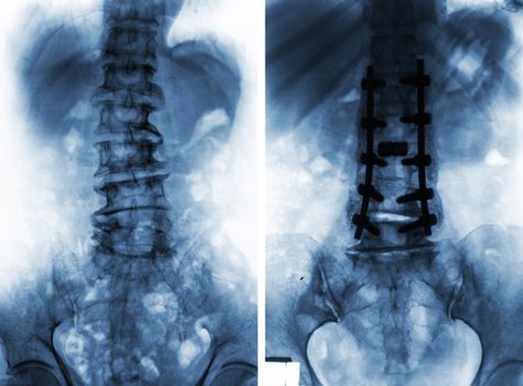 Spondylosis . Film x-ray of lumbar spine and comparison between before surgery ( left image ) and after surgery ( right image ) . Patient was operated and internal fixed . Lateral view .