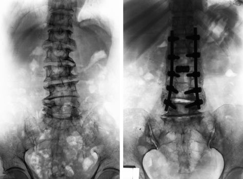 Spondylosis . Film x-ray of lumbar spine and comparison between before surgery ( left image ) and after surgery ( right image ) . Patient was operated and internal fixed . Front view .