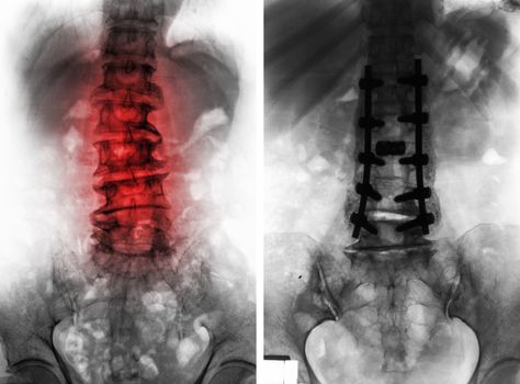 Spondylosis . Film x-ray of lumbar spine and comparison between before surgery ( left image ) and after surgery ( right image ) . Patient was operated and internal fixed . Front view .
