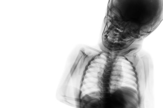 X-ray upper half body of child and blank area at left side .