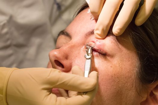 Healthcare concept - Chalazion during eye examination and operation - Female