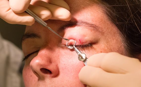 Healthcare concept - Chalazion during eye examination and operation - Female