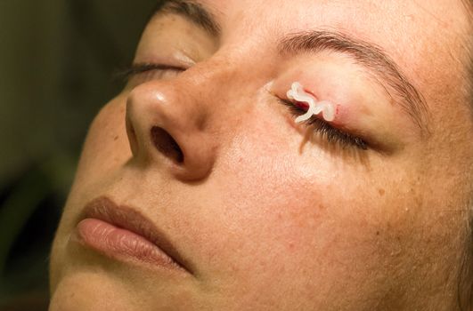 Healthcare concept - Medicine on eye - Chalazion during eye examination and operation - Female