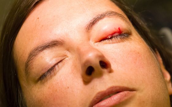 Healthcare concept - Chalazion during eye examination and operation - Female