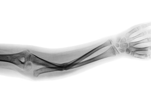 Film x-ray forearm AP show fracture shaft of ulnar bone .