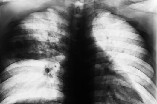 Lobar Pneumonia . Film chest x-ray show patchy infiltrate at right middle lung from Mycobacterium tuberculosis infection ( Pulmonary tuberculosis ) .