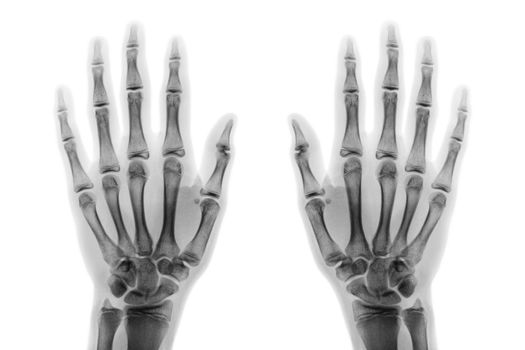 Film x-ray both hand AP show normal human hands on white background ( isolated ) .