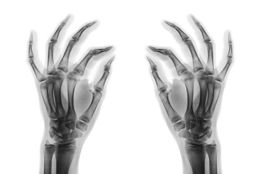 X-ray normal human hands on white background . Oblique view .