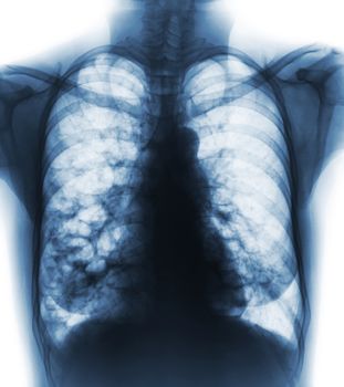 Bronchiectasis . X-ray chest show multiple lung bleb and cyst due to chronic infection . Front view .