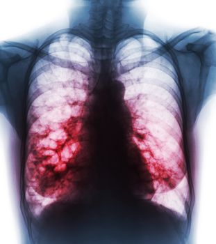 Bronchiectasis . X-ray chest show multiple lung bleb and cyst due to chronic infection . Front view .