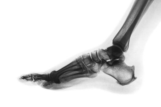 X-ray normal human foot . Lateral view . Invert color style .