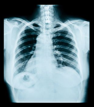 medical radiograph of thorax. ray, lungs, chest