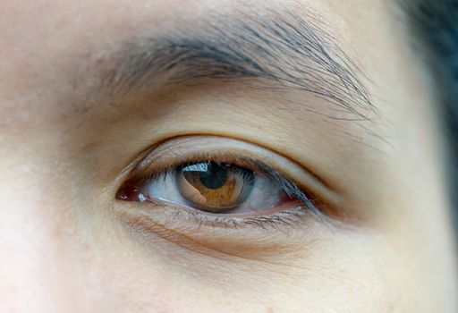 Macro shot of Asian middle aged woman brown eyes with wrinkles under the eyes and showing veins in eyes. Eyelid problem need surgery for lift up