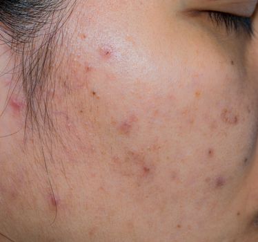 Acne and acne spot on oily face skin of Asian woman. Concept before acne treatment and face laser treatment for get rid of dark spot post-acne. Closed comedones and open comedones on facial skin