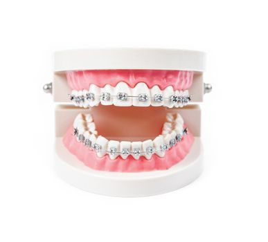 tooth model with metal wire dental braces isolated on white background.