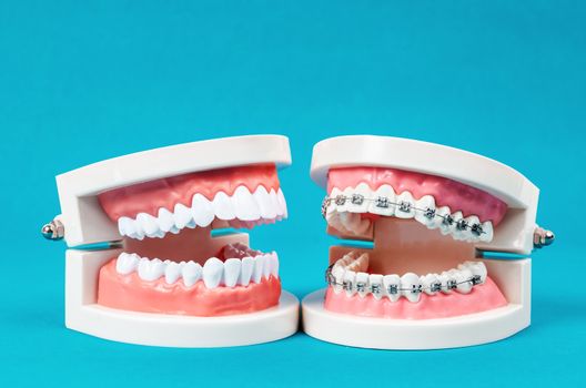 Compare tooth model and tooth model with metal wire dental braces on blue background.