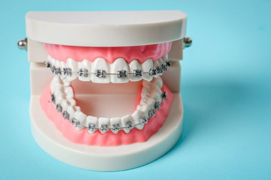 tooth model with metal wire dental braces on blue background.