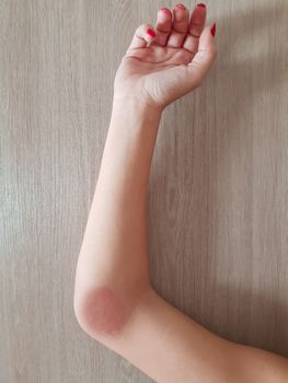 Red rash of the patient who was bitten by an insect