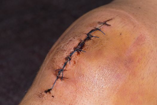 Male knee after surgical operation, knee replacement. Knee surgery in the hospital