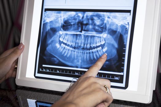 DEntal panoramic x-ray in wiever  with finger pointing