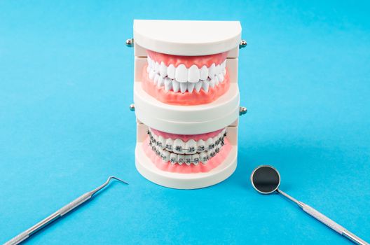 Compare tooth model and tooth model with metal wire dental braces and equipment on blue background.