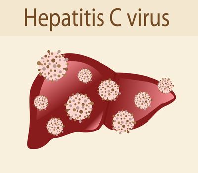Hepatitis C virus attack the liver vector illustration on a white background isolated