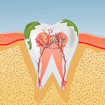 illustration of tooth with plaque