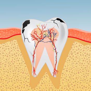 illustration of tooth with caries