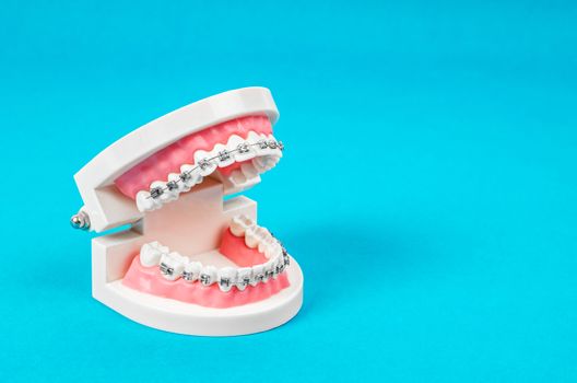 Tooth model with metal wire dental braces on blue background with empty space for your text or message.