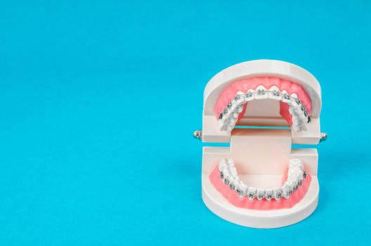 Tooth model with metal wire dental braces on blue background with empty space for your text or message.