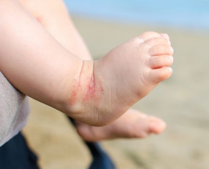 atopic dermatitis newborn feet eczema