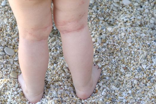 skin irritation newborn atopic dermatitis legs